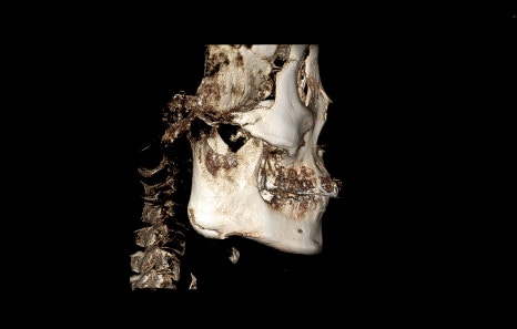 Square Jaw Surgery: What Are a Retracted Jaw and a Protruding Jaw? image 1