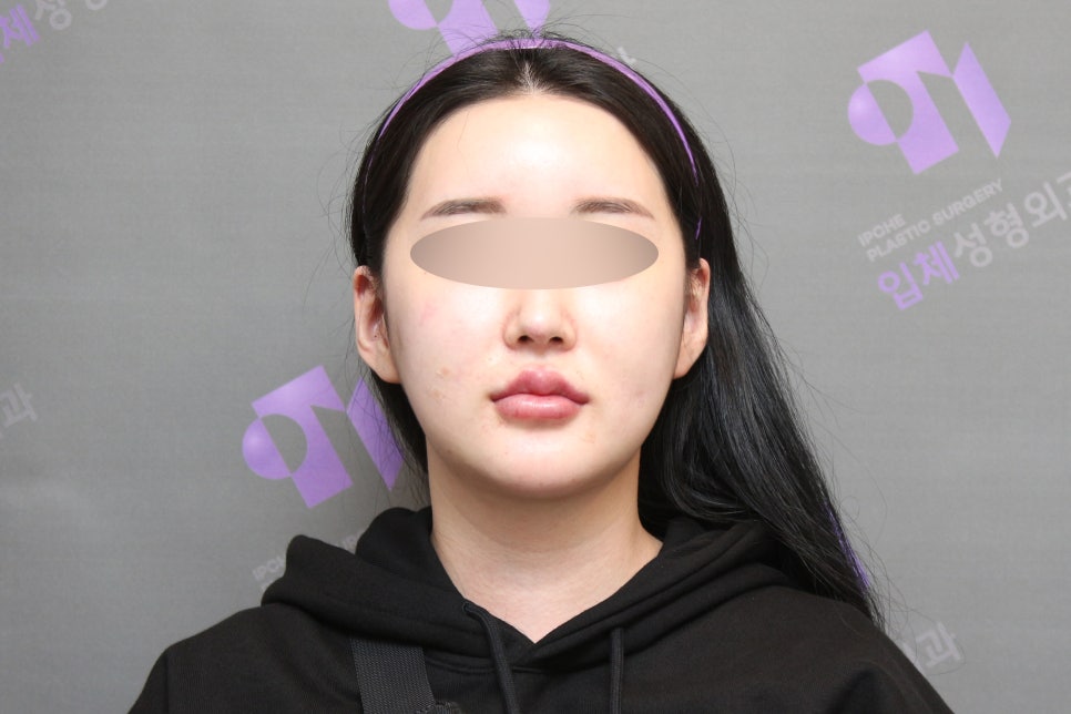 Why Cheekbones Show When You Smile, and Why Cheekbone Surgery May Not Help - Explained by a Specialist image 6