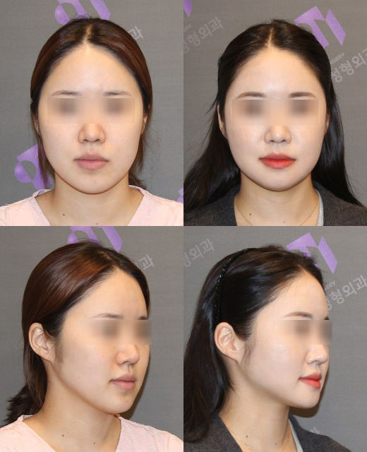 긴턱 교정은 어떤 수술이 좋을까요? 턱끝축소술의 한계와 실제 결과 관련 이미지 4