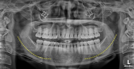 Does a Low Nerve Canal Make Square Jaw Surgery Difficult? Ways to Improve Frontal Results image 1