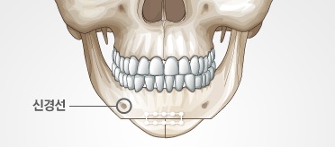 What Is Chin Surgery? image 4