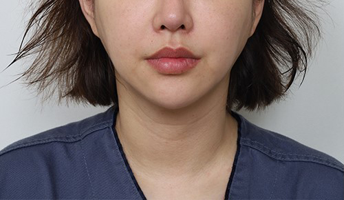 Post-Contour Surgery Cheek Hollowing and a Bumpy Jawline: Cases of Soft Contouring and Facelift Surgery image 1