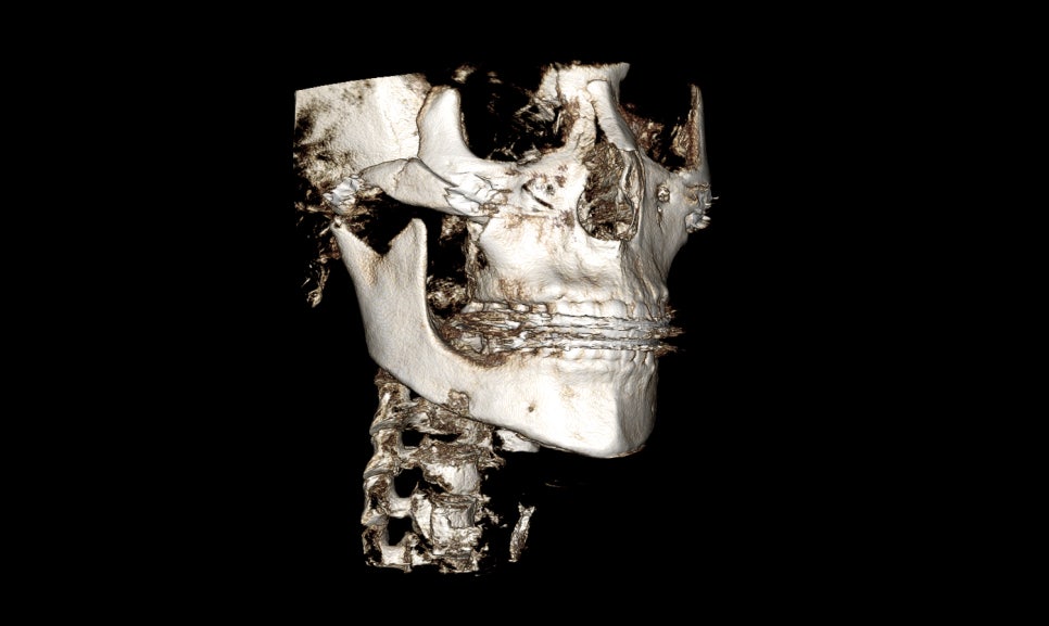 Why Are There So Many Methods for Cheekbone Surgery? A Look at Osteotomy Methods image 7