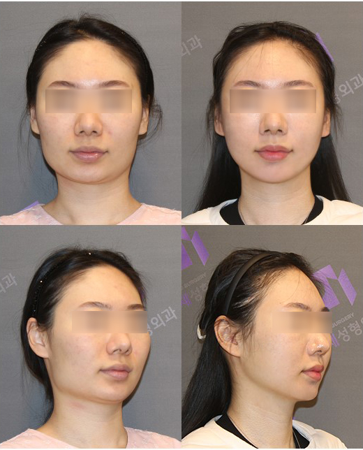 광대수술 후 입벌리기 왜 조심해야 할까요? 관련 이미지 7
