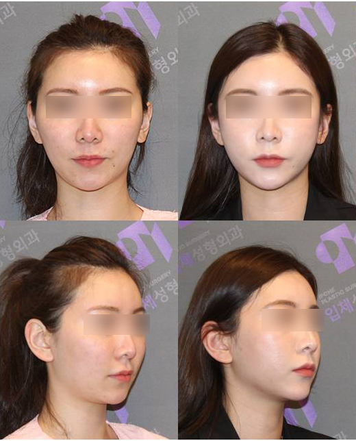 땅콩형 얼굴은 어떻게 개선할 수 있을까요? 관련 이미지 2