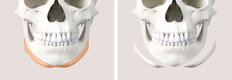 [Chin Surgery] Learning About Contouring Shaving and T-Osteotomy with Real Patient Cases (3) image 2
