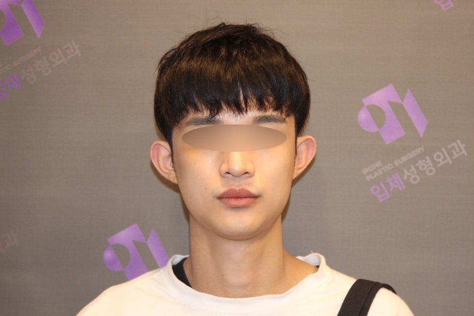 Male Facial Contouring (Square Jaw Surgery, Cheekbone Surgery, Chin Surgery) - Explained by a Specialist image 3