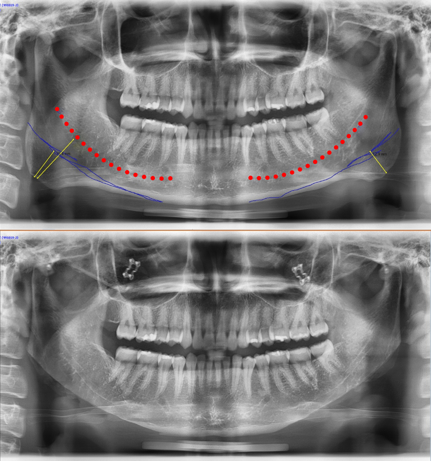 If the nerve line is low, can’t you have jaw angle surgery? Is there any way to make the front view slimmer? image 1