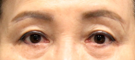 중년눈성형, 눈꺼풀 처짐은 어떻게 해결해야 할까요? 관련 이미지 6