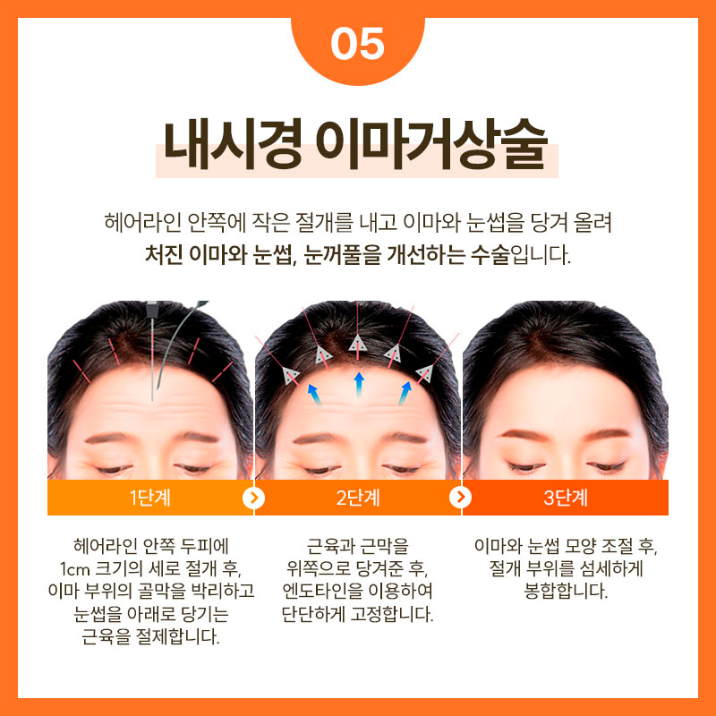 SMAS Facelift Surgery Effective for Improving Facial Sagging and Wrinkles image 6