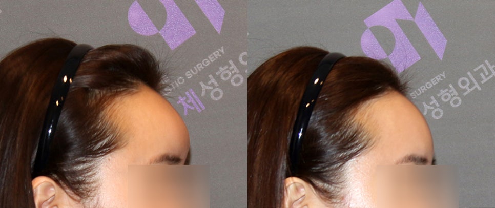 Forehead Fat Grafting Side Effects: Is There a Way to Remove Excess Fat? image 8