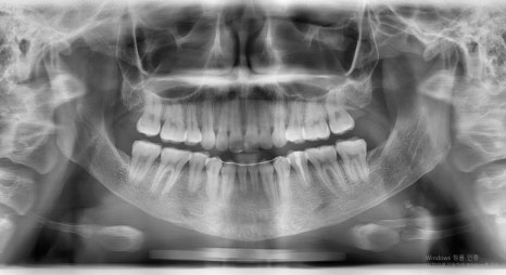 Which Surgery Do I Need: Contouring Surgery or Double-Jaw Surgery? image 22