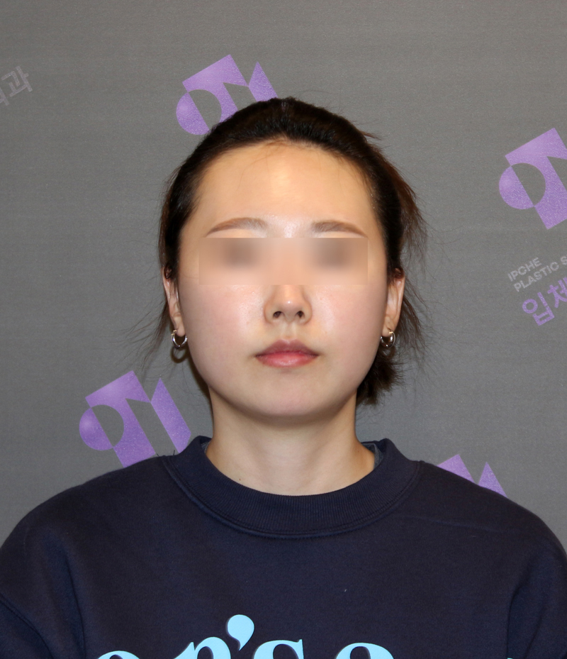 광대뼈 비대칭, 광대축소술로 교정할 수 있을까요? 관련 이미지 7