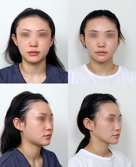 원장님, 윤곽수술하면 예뻐지는 게 맞나요? 관련 이미지 9