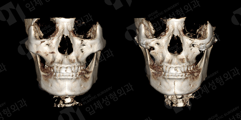 Would It Be Better to Use Absorbable Pins in Facial Contouring Surgery? About the Types, Advantages, and Disadvantages of Fixation Pins! image 3