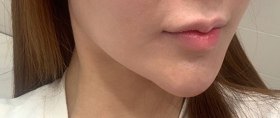 A Complication Called Chin Surgery Side Effects image 1