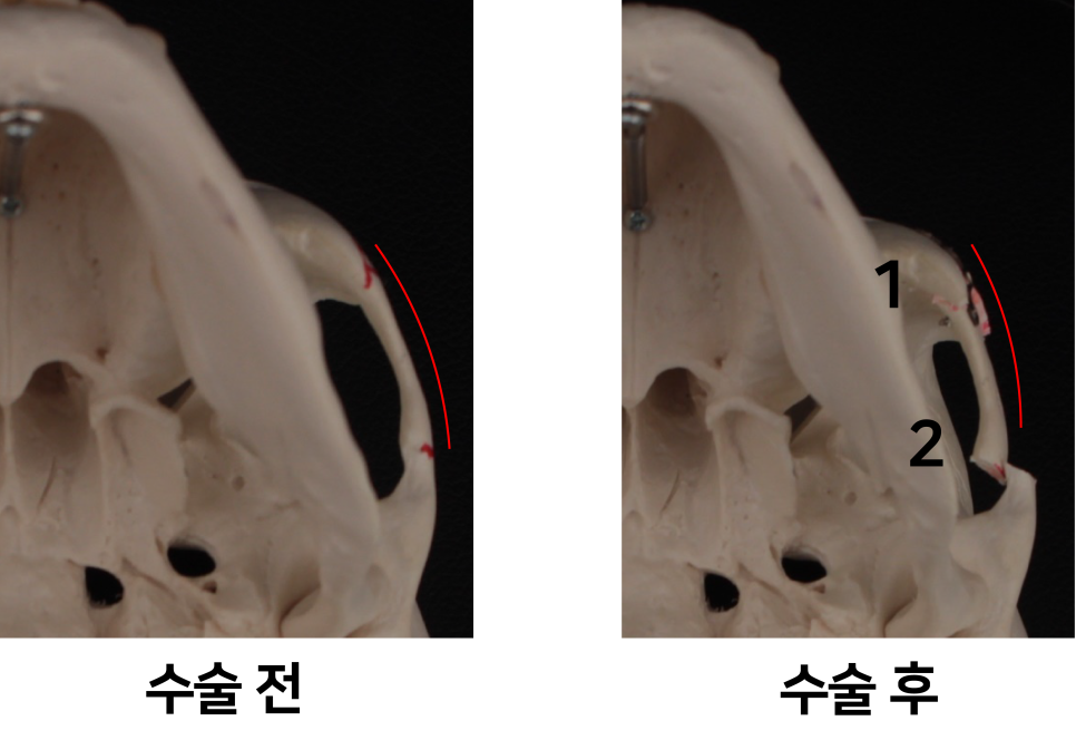 Lateral Cheekbone Reduction, 230-Degree Three-Dimensional Cheekbone Reduction from the Front to the Side image 2
