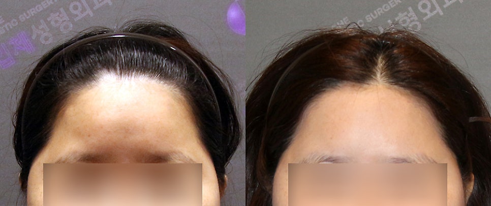 Forehead Fat Grafting Side Effects: Is There a Way to Remove Excess Fat? image 9