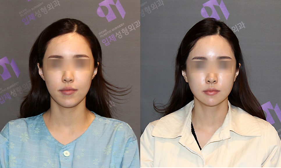 Consultation and Design Before Facial Contouring Surgery image 6