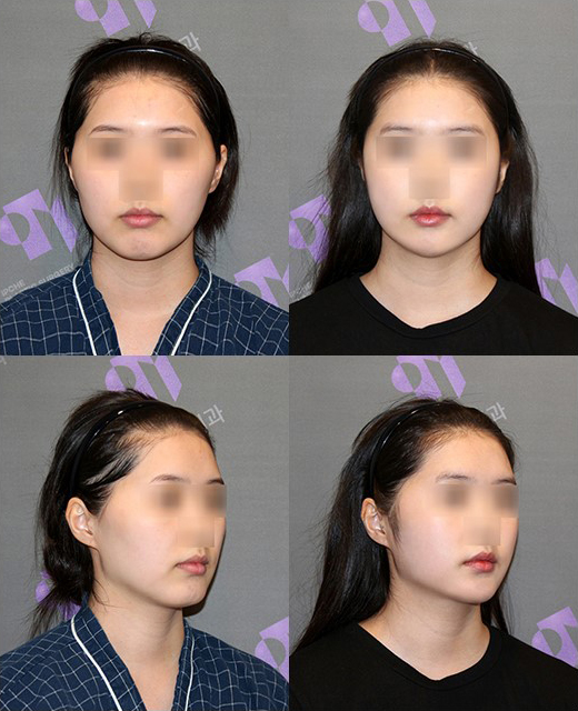 Is There a Way to Address the Secondary Angle That Appears After Chin Surgery? image 2