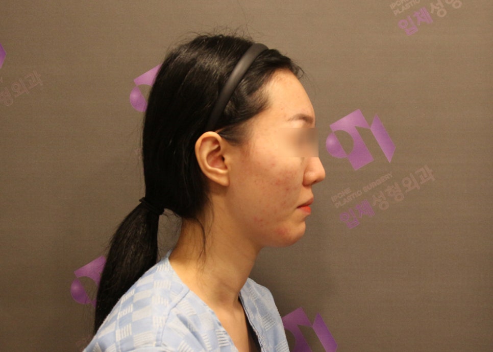 윤곽수술과 같이 하면 좋은 수술 : 귀족수술 관련 이미지 1