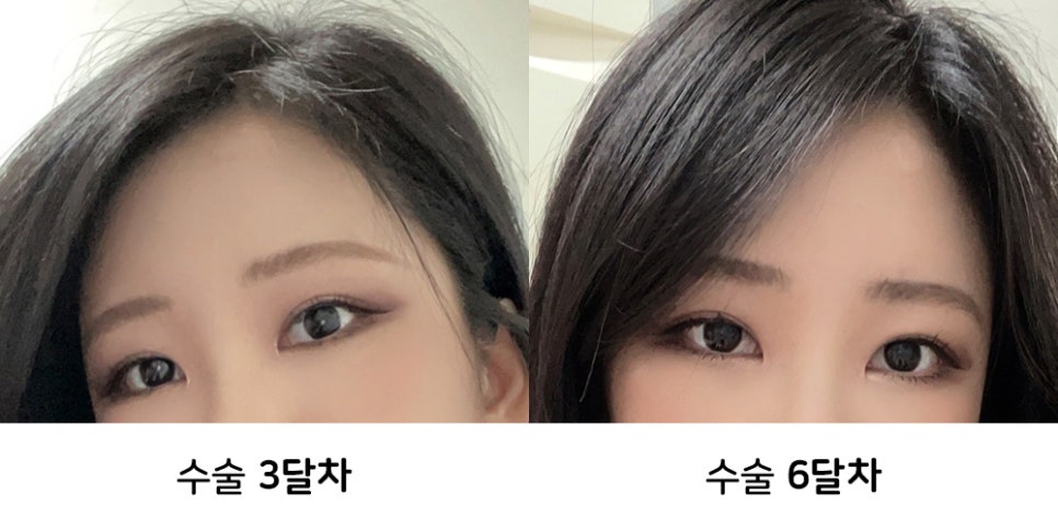 내시경이마거상술 붓기와 회복기간, 후기사진과 함께 알아보기 관련 이미지 3