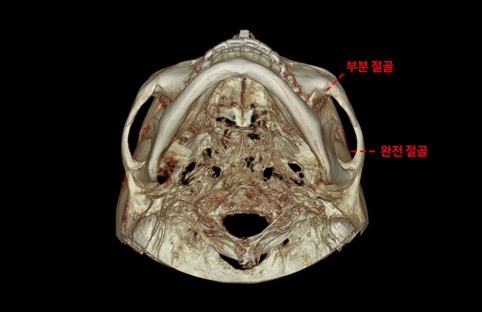 How Much Effect Does 230-Degree Zygoma Reduction Surgery Have? image 1