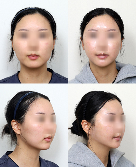 How Much Effect Does 230-Degree Zygoma Reduction Surgery Have? image 10