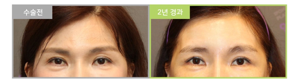 처진 눈과 눈매교정이 눈수술이 아닌 이마눈썹거상술을 해야한다고? 관련 이미지 4
