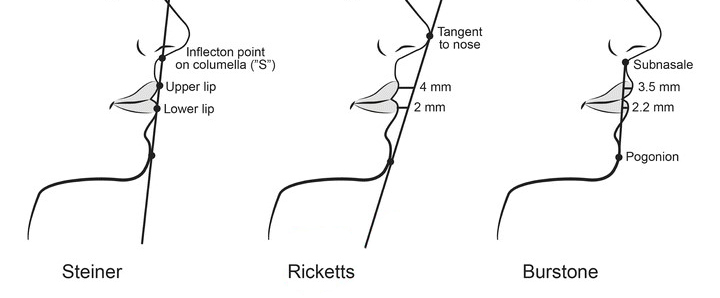 What Surgery Is Best for Correcting a Short Chin or Recessed Chin? The Limits of Chin Surgery and the Actual Results image 1