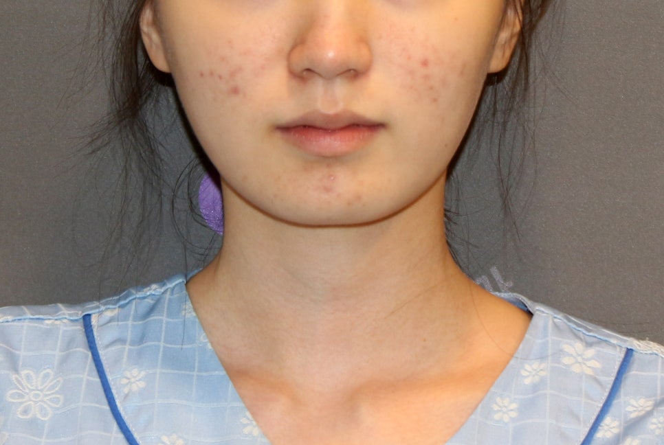턱끝수술부작용, 이중턱이 생기는 이유는? - 전문의가 알려드립니다. 관련 이미지 6