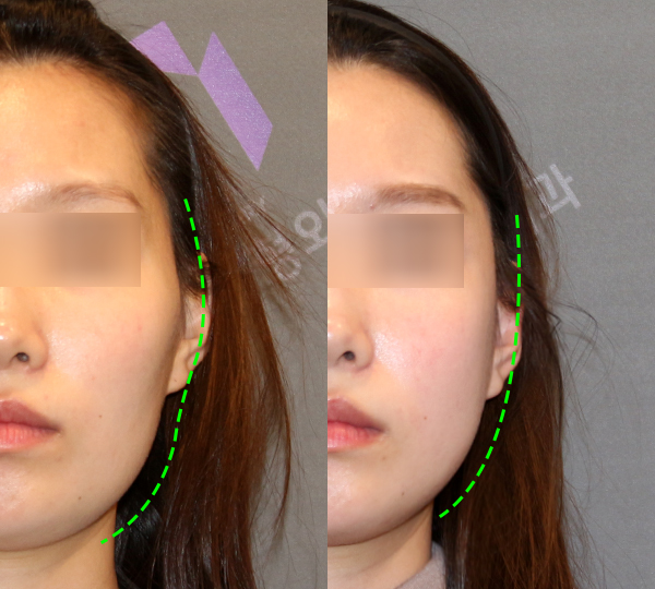 Cheekbone Reduction Surgery: A 2–3 mm Difference in the Side Cheekbones Makes a Big Change in the Face. image 5