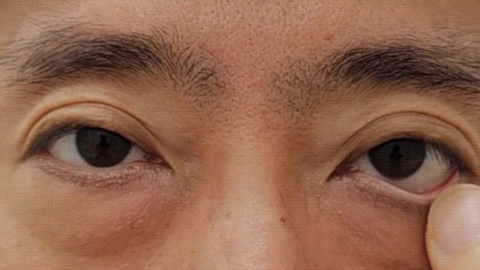 50대 남자눈성형 하안검 수술 케이스 - 세대별 분석으로 접근한 해결 전략 관련 이미지 3