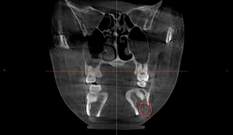 Are There People Who Can’t Have Cortical Ostectomy Surgery for a Frontal Square Jaw Effect? image 6
