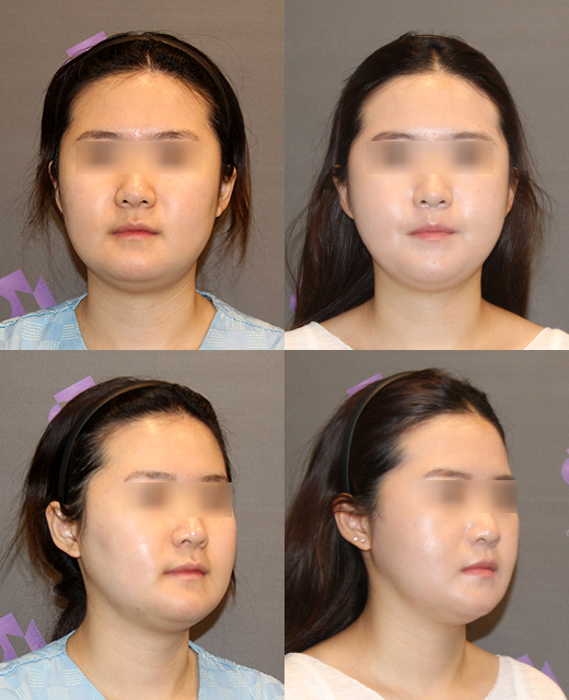The Story After Cheek Dimple Correction image 3