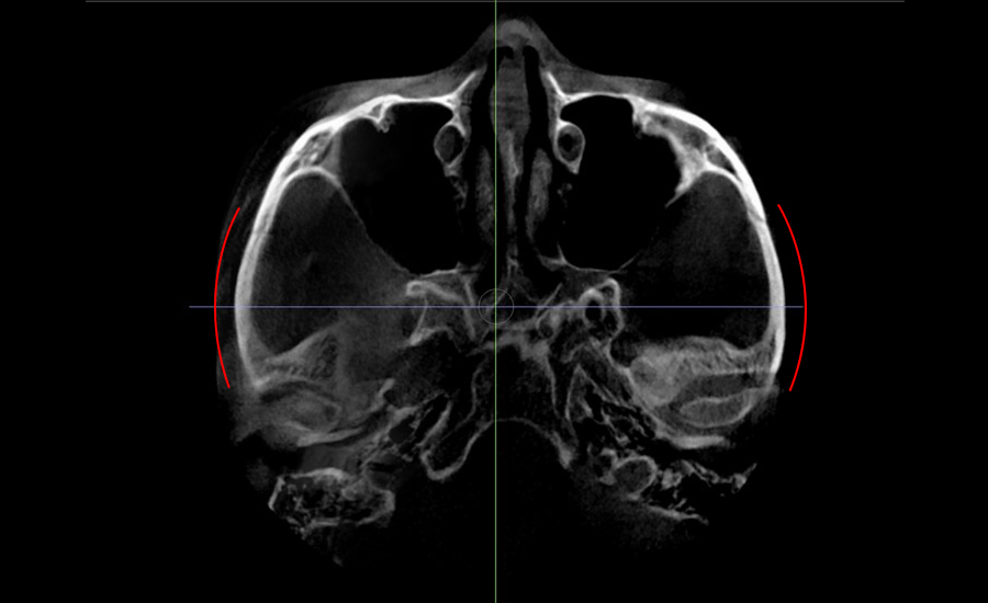 Back Cheekbone Shaving? Osteotomy? Do You Really Need It? image 1