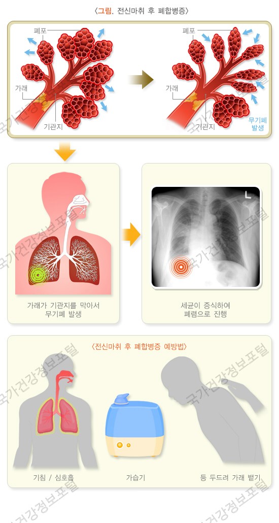 전신마취 후유증에 대해서 알아봅시다. 관련 이미지 5