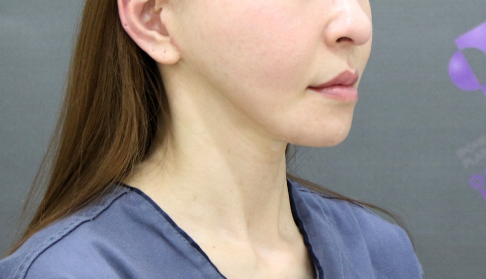 If There Is No Jaw Angle Below the Ears, Is It a “Dog Jaw”? What Is a Dog Jaw? image 5