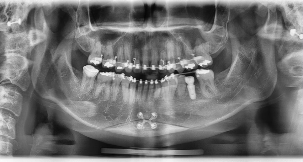 Long Chin, Long Face Contouring - Cases That Do Not Require Double Jaw Surgery image 14