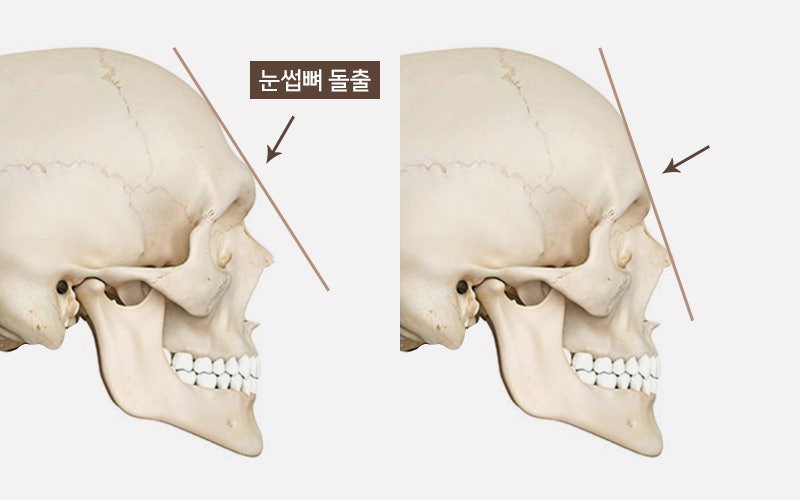 How Should Brow Bone Prominence Be Addressed? image 2