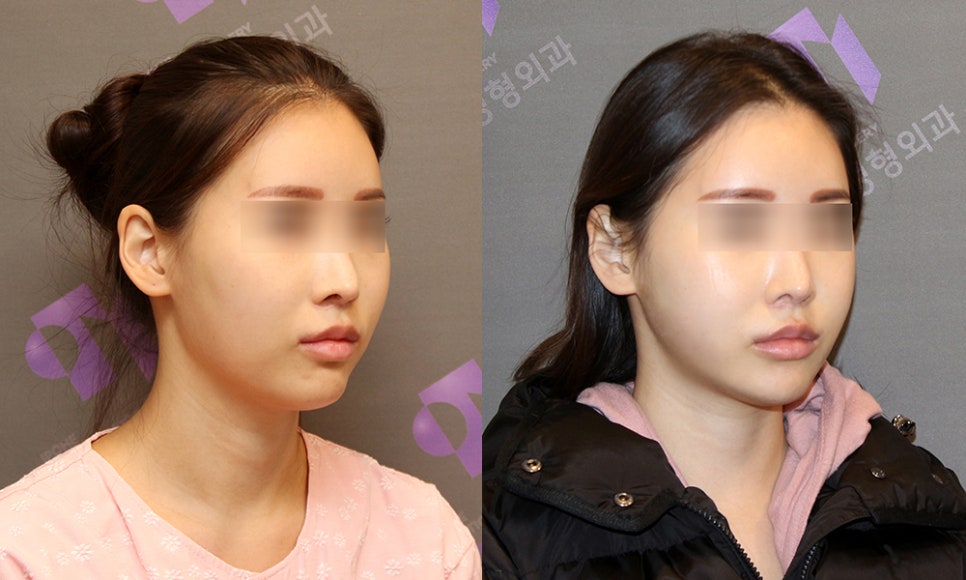 Review of Side Cheekbone Reduction Surgery image 5