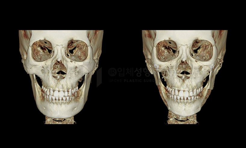 How Often Does Inflammation Occur After Facial Contouring Surgery? image 1