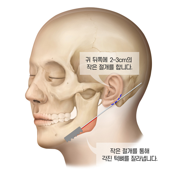 수면마취로 윤곽수술을 할 수 있나요? 관련 이미지 3