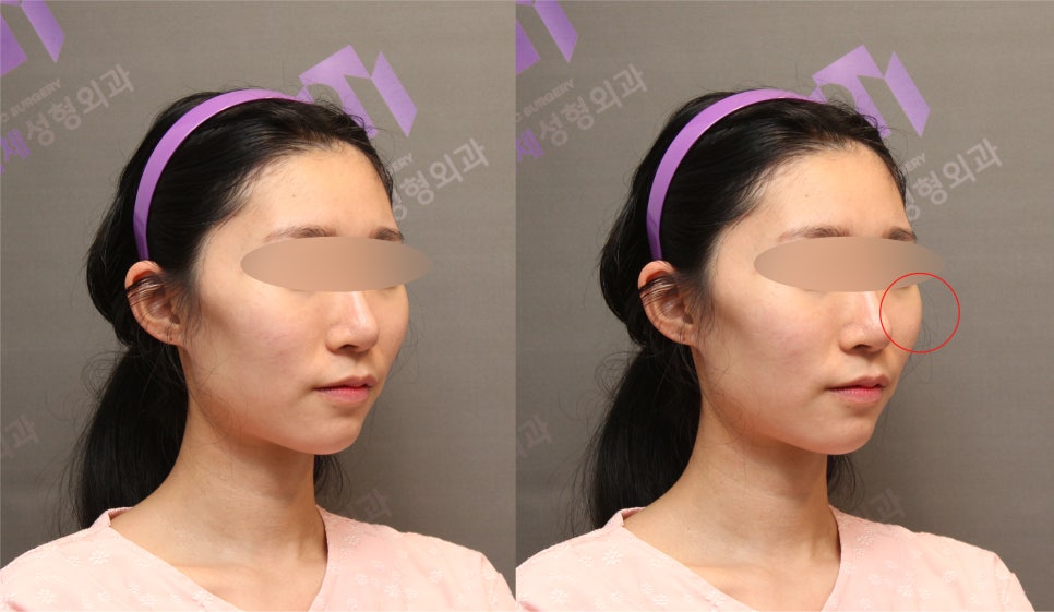 45-Degree Cheekbone Reduction Surgery Review, Let’s Look at Cases Together - Information from a Specialist image 2