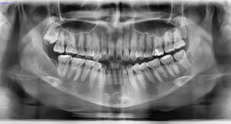 턱끝수술부작용, 이중턱이 생기는 이유는? - 전문의가 알려드립니다. 관련 이미지 3