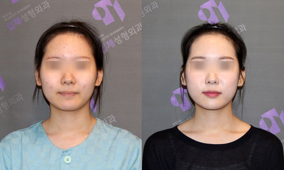 Consultation and Design Before Facial Contouring Surgery image 1
