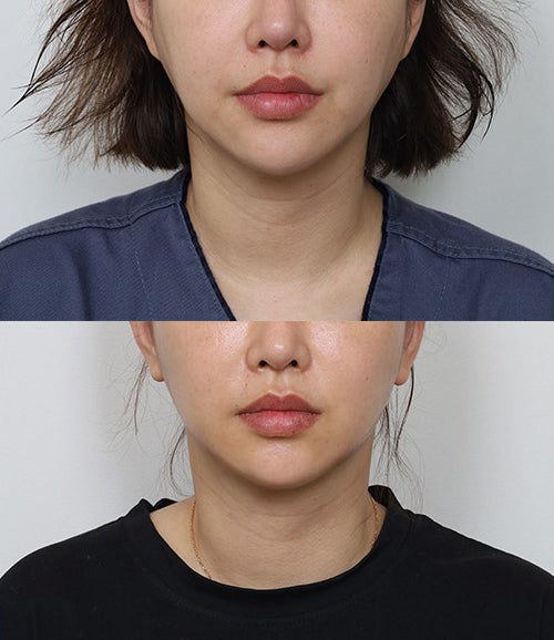 Post-Contour Surgery Cheek Hollowing and a Bumpy Jawline: Cases of Soft Contouring and Facelift Surgery image 2