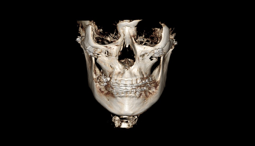 How Much Effect Does 230-Degree Three-Dimensional Zygomatic Reduction Have? image 8