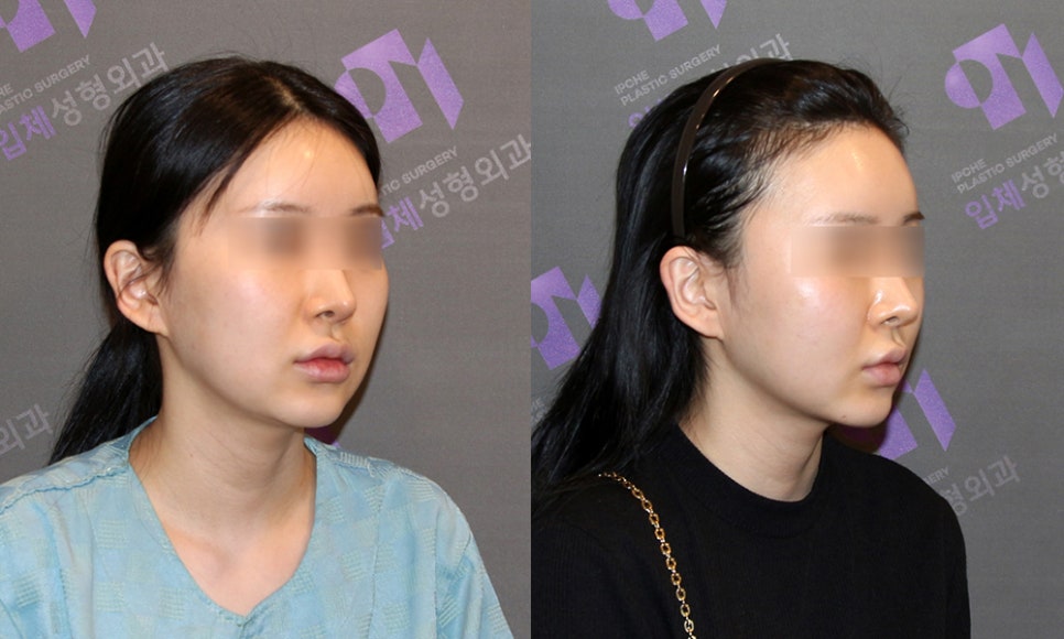 광대수술의 역사, 광대축소술 절골 방법에 대해서 관련 이미지 4