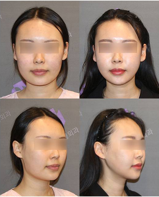 안면윤곽성형외과 실패하는 사람들의 공통점 관련 이미지 2